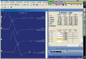 Graph obtained during NCV procedure