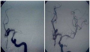 Before and after thrombolytic therapy